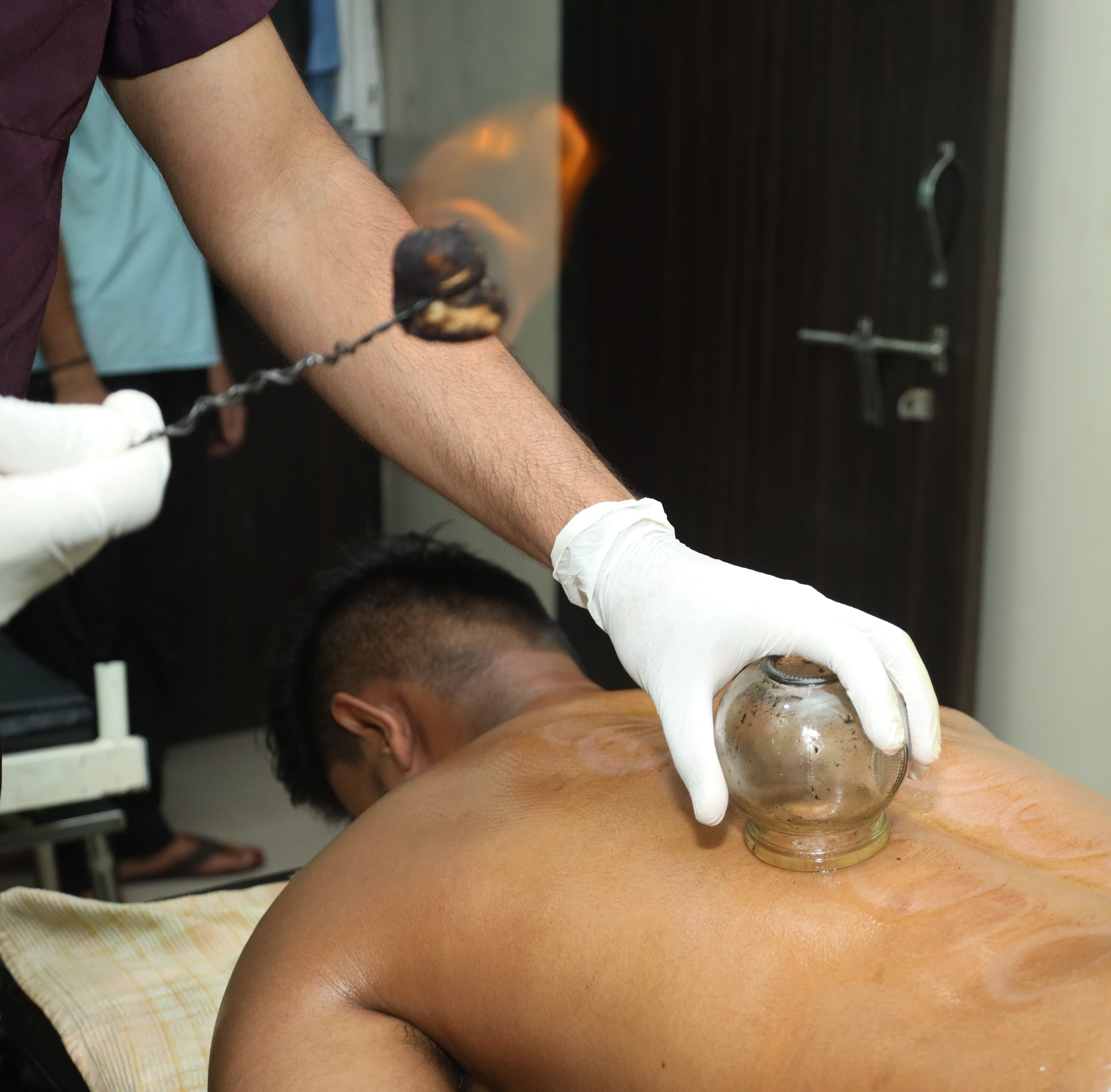 Hot cupping therapy
